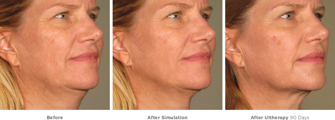 ultherapyfullface_1 Glow Medical Aesthetics